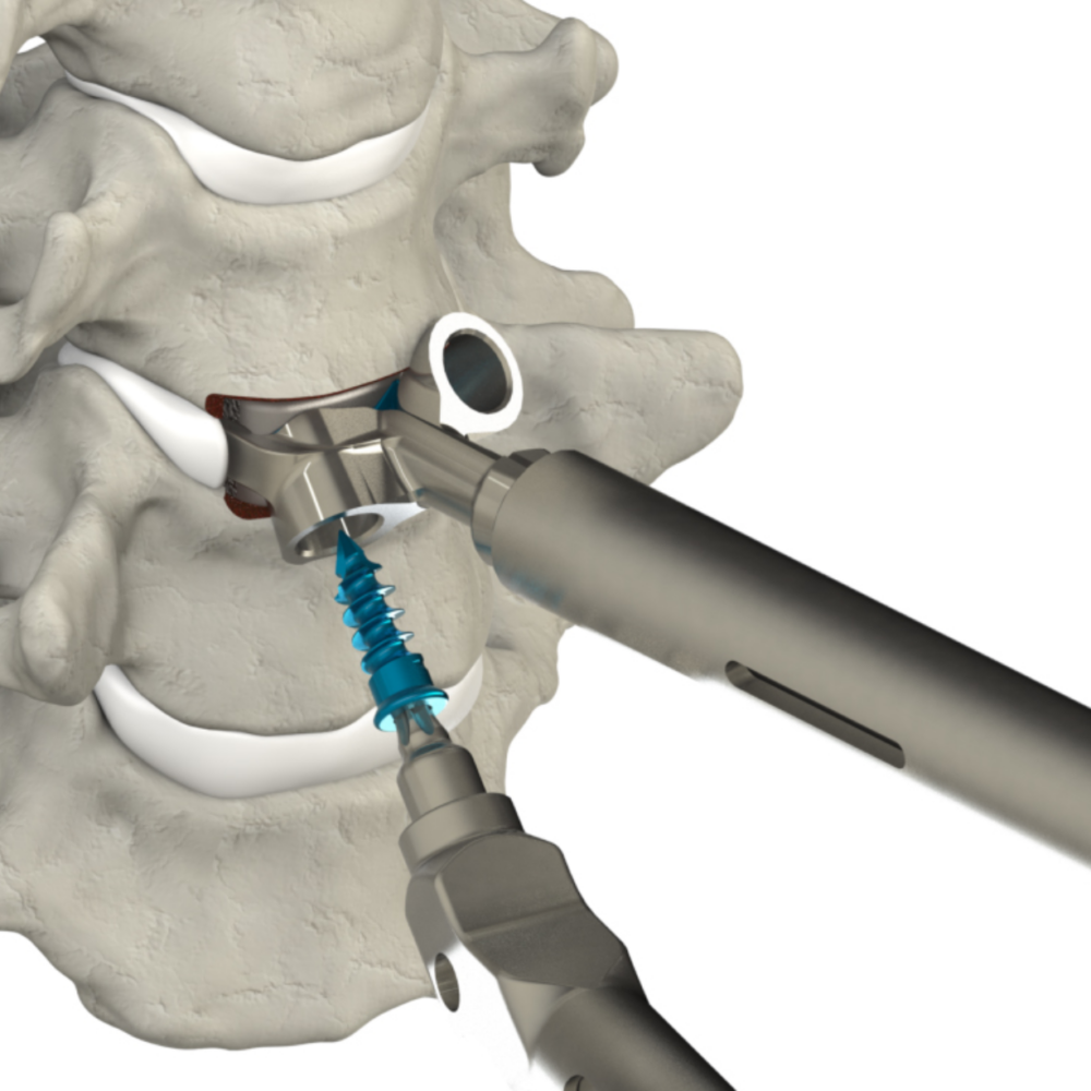 Cervical Spine Truss System Stand Alone Web Medical