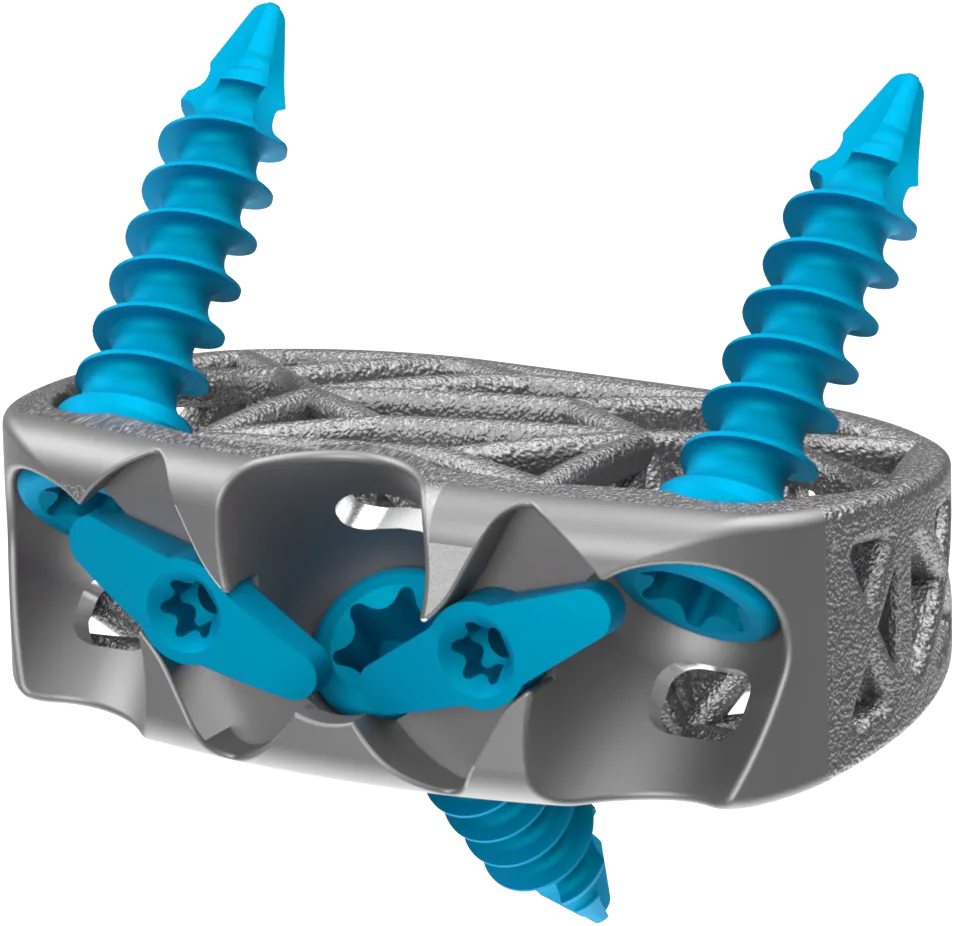 Anterior Spine Truss System™ – Stand Alone