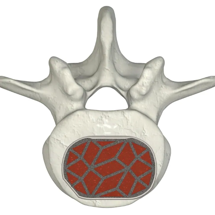 ASTS anterior view within the vertebral body