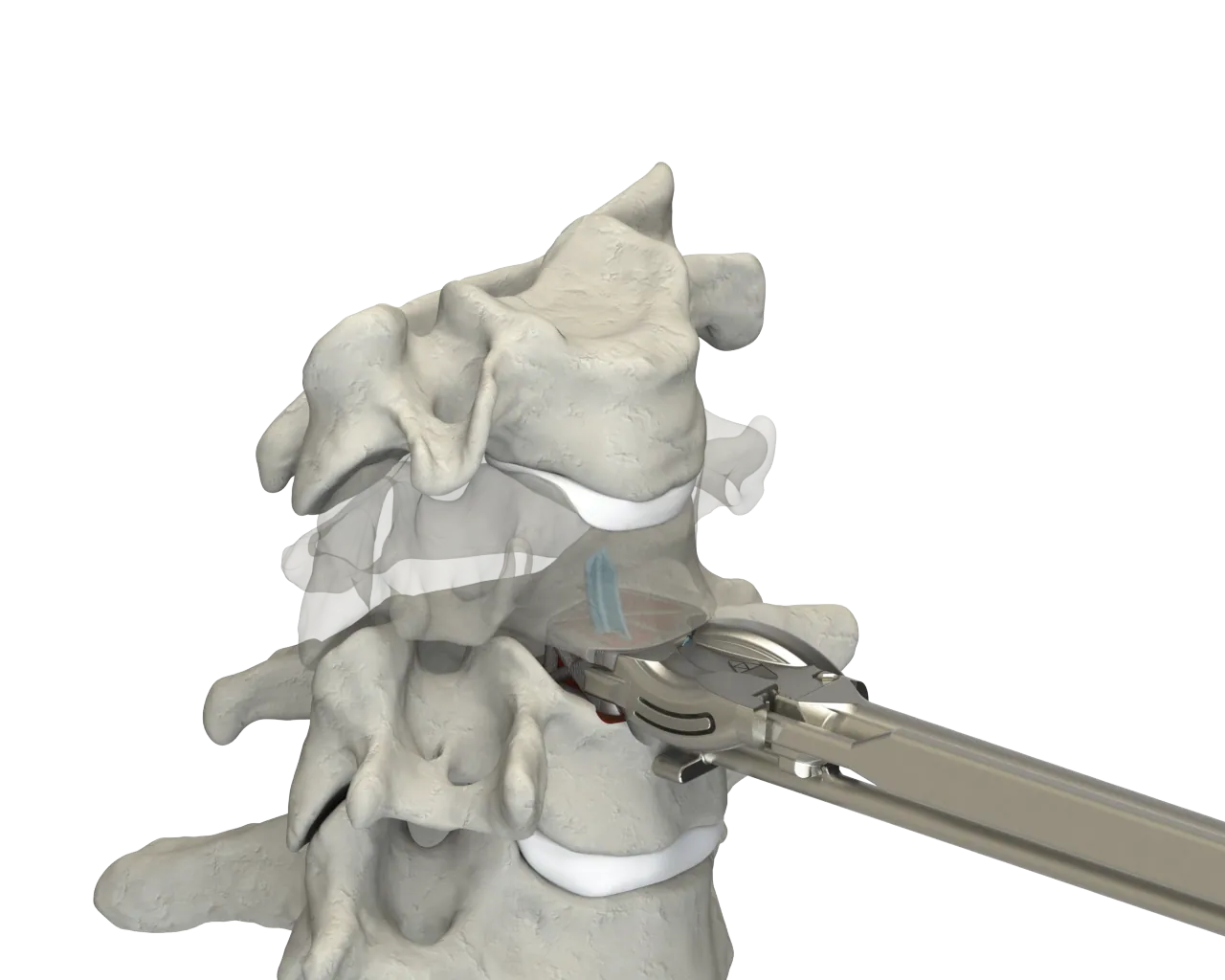 CSTS-SA with Anchor Fixation insertion into the disc space