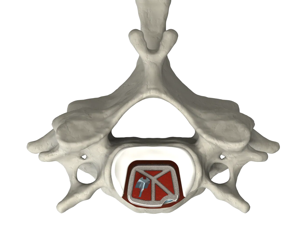 CSTS-SA with Anchor Fixation superior view within the vertebral body