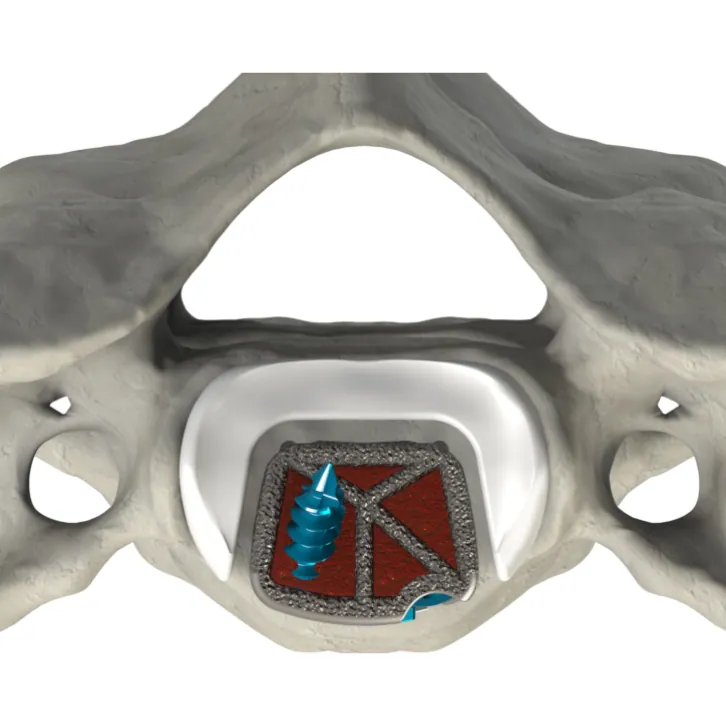 CSTS-SA posterior view within the vertebral body