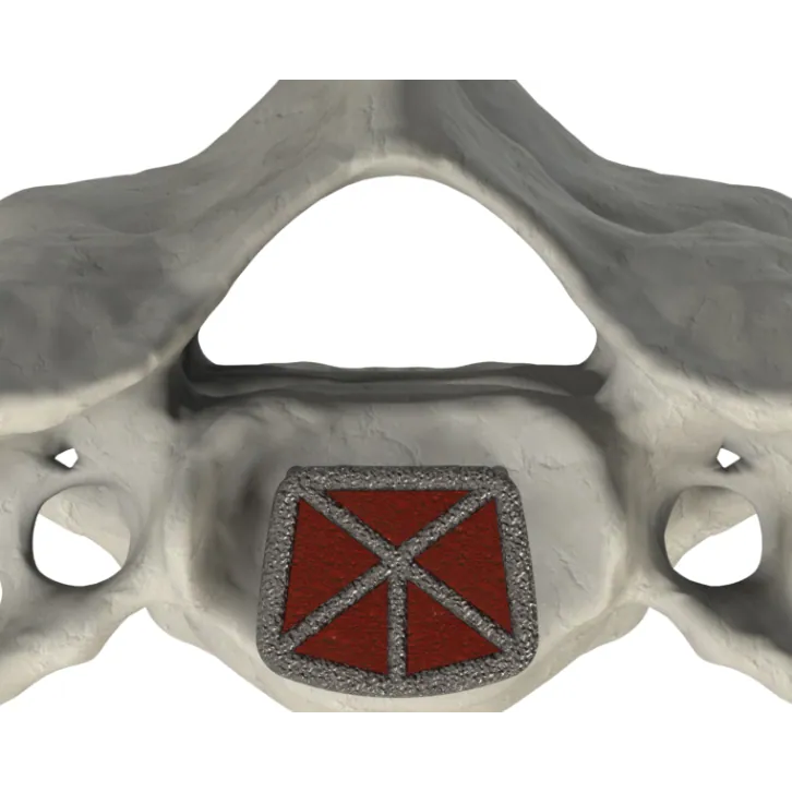 CSTS anterior view within the vertebral body