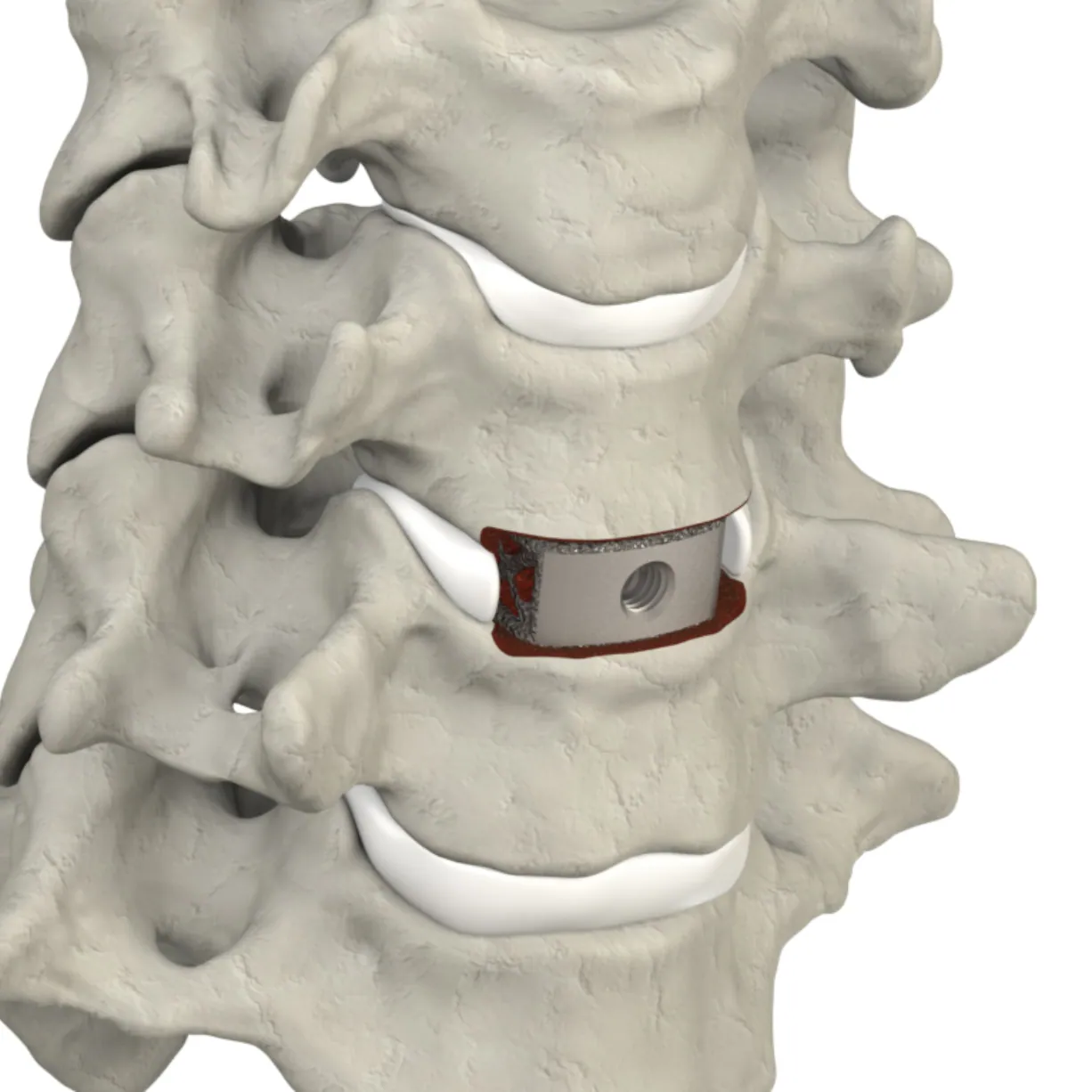 CSTS placed within the cervical spine