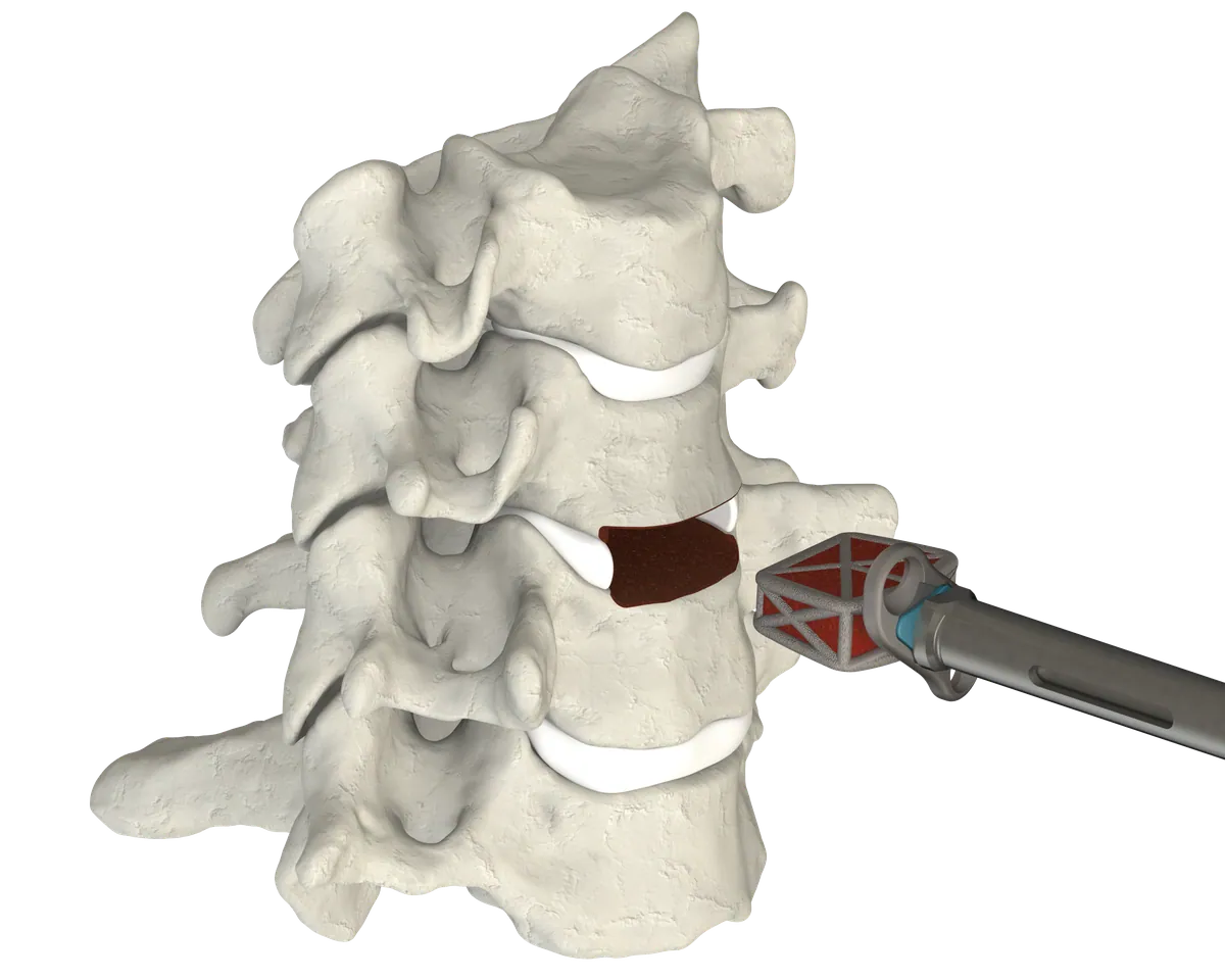 CSTS 2.0 insertion into the disc space