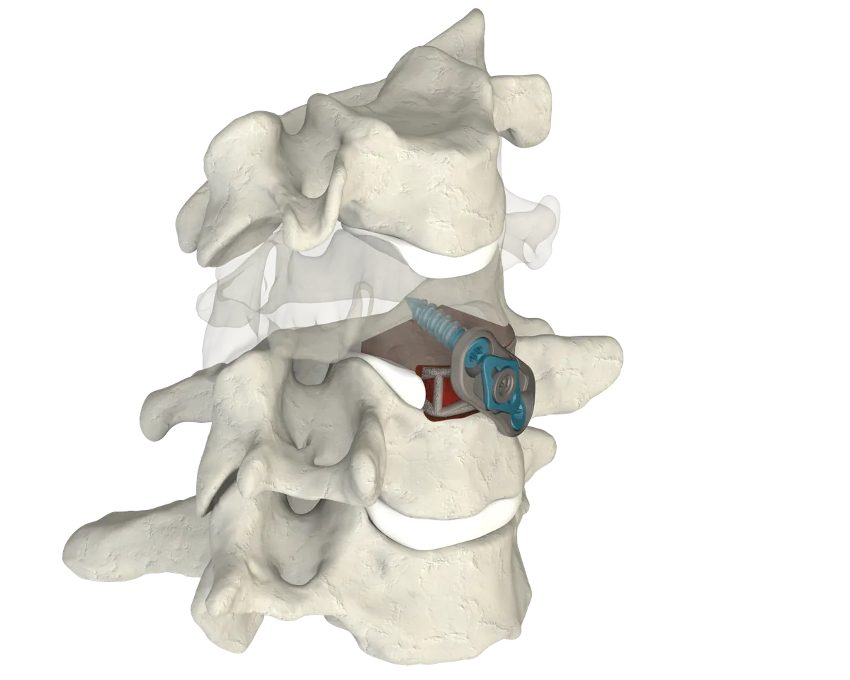 CSTS 2.0 placed with integrated plate and screw