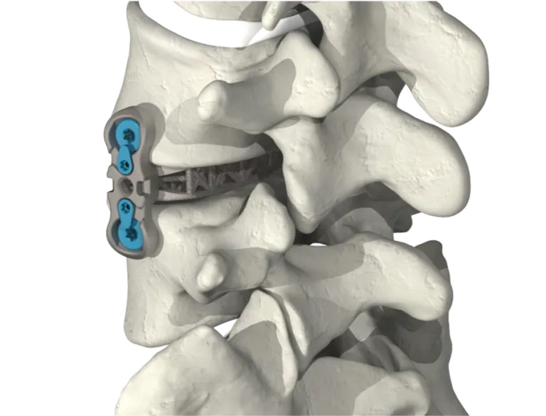 Lumbar Spine Plating Solution placed within the lumbar spine