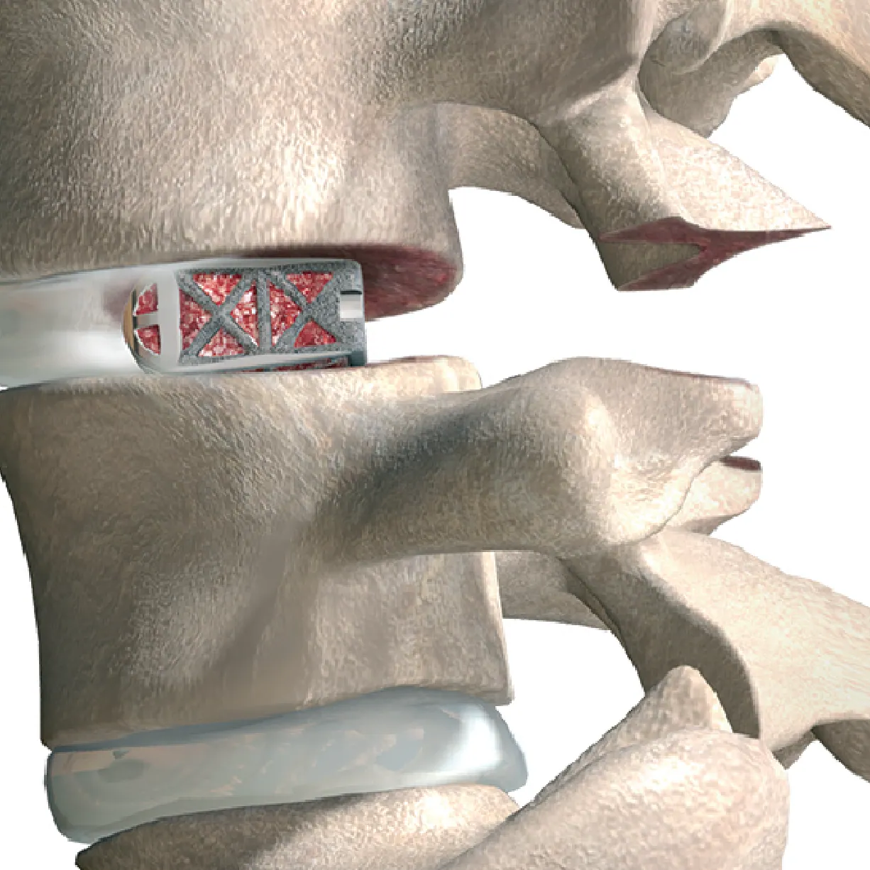 PSTS lateral view within the lumbar spine