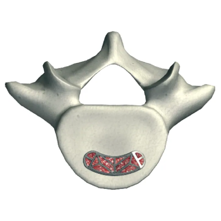 PSTS posterior view within the vertebral body