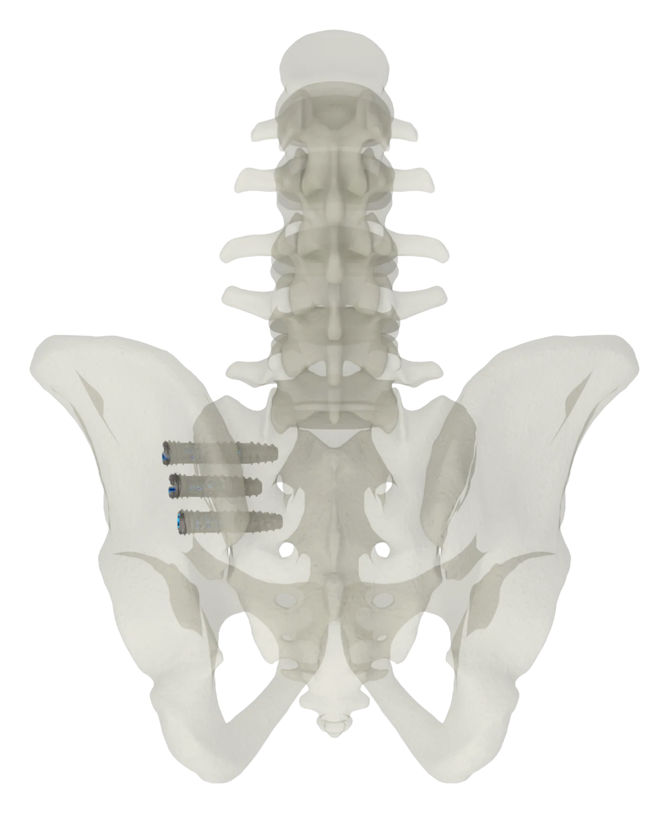 SJTS lateral approach, outlet view of screw placement