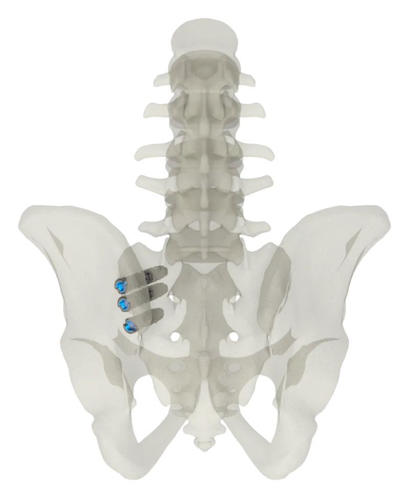 SJTS posterior approach, outlet view of screw placement
