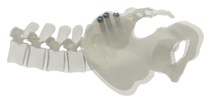 SJTS posterior approach, lateral view of screw placement
